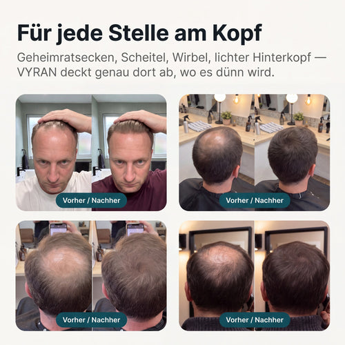 VYRAN Vorher / Nachher — Geheimratsecken, Scheitel, Wirbel, lichter Hinterkopf